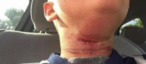 A photograph of Quincy Chivers's neck following the incident in Claremont, NH. The picture was taken and posted on Facebook by Chivers's mother, Cassandra Merlin. 