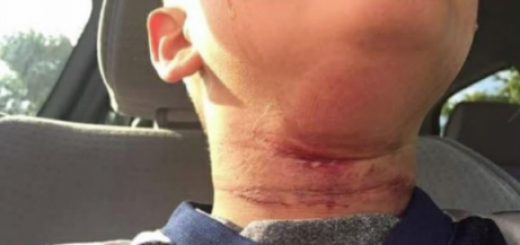A photograph of Quincy Chivers's neck following the incident in Claremont,
NH. The picture was taken and posted on Facebook by Chivers's mother,
Cassandra Merlin.